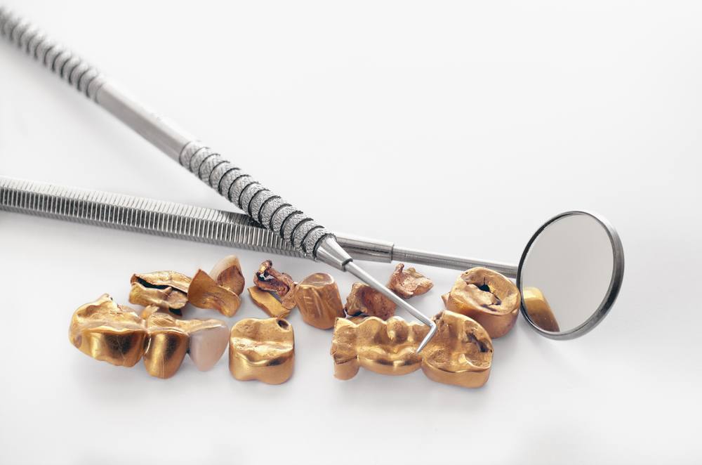 The 4 Best Places to Sell Dental Gold Faster